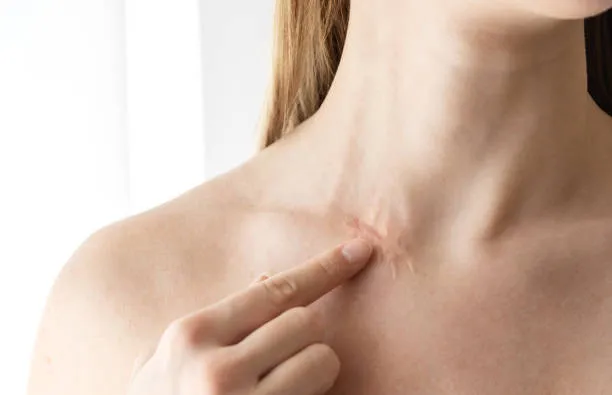 Skin Grafts using Cyanoacrylate Adhesives were found to Heal with much Less Scarring Skin Grafts using Cyanoacrylate Adhesives were found to Heal with much Less Scarring