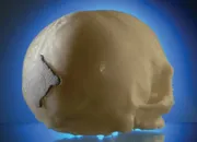 Resobone Patch on Skull Model Resobone Patch on Skull Model