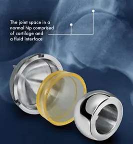 TriboFit Hip System with PCU Acetabular Buffer TriboFit Hip System with PCU Acetabular Buffer